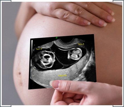 Twin-Twin Transfusion Syndrome-img Twin-Twin Transfusion Syndrome